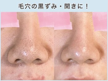ロエヴェ(ROEWE)の写真/新聞にも取材された毛穴と素肌の専門店!施術実績10万人超!一人ひとりに合わせたケアで理想の素肌を目指す!