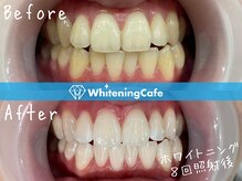 ホワイトニングカフェ 鷺沼店(WhiteningCafe)/ホワイトニングビフォーアフター