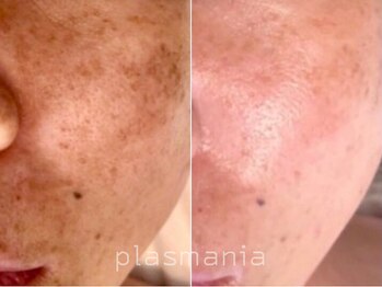 サロンドエテ(salon de ete)/プラズマニア症例