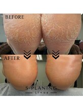 リノア(Linoa)/韓国式足裏角質ケア-splaning-