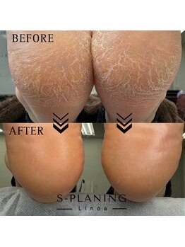 リノア(Linoa)/韓国式足裏角質ケア-splaning-