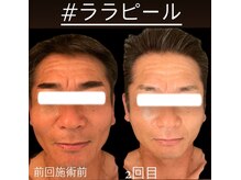 ジーニー(Genie)/ララピール