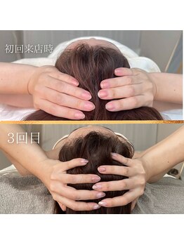 タワワ(TaWaWa)/30代女性　NR小顔施術3回目