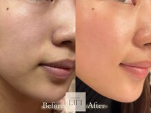 エル 麻布十番/たるみ/小顔/毛穴/フェイシャル