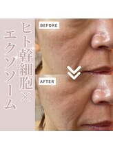 テセラ(Tethere)/ヒト幹細胞×エクソソーム