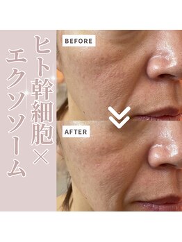 テセラ(Tethere)/ヒト幹細胞×エクソソーム