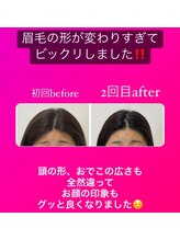 顔凛(カオリン)/オデコの形もかわる小顔矯正