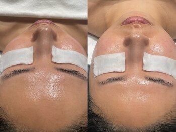 フロムミー 銀座本店(FROM ME)/3Xダーマ・ジオ