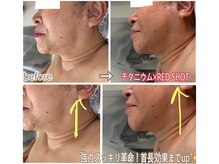 アルページュ(Arpege)/一撃チタニウム×RED SHOT♪好評