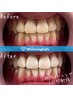 【NEWOPEN限定価格】まずはお試し♪ホワイトニング10分×2回￥6,225→￥3,980