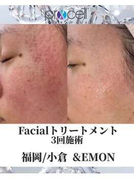 アンドエモン(&EMON)/【お顔】プロセル効果