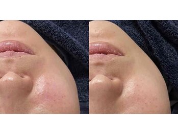 アドビューティ(Add Beauty)/≪たるみ改善／RFリフティング≫