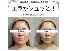 小顔矯正＋高濃度酸素オイル造顔マッサージ40分でこの変化！
