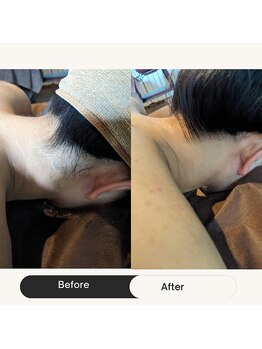 チューズコレクション(choose collection)/脱毛