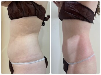 エイシスグロウ(asis glow.)/効果写真