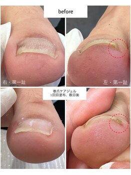 ケアプラス(care plus)/巻爪ケアジェル