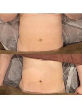 トータルエステティック ジョワイユ(JOYEUX)/お腹脂肪集中ケア