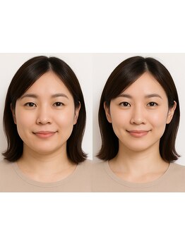 ホウレイ線・たるみ改善！予防ケア