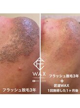 アンシャンテドゥ(enchante.deux)/最新美肌脱毛　髭全体