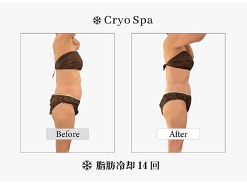 クリオスパ せんげん台駅前店(Cryo Spa)/脂肪冷却Before/After