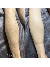 カナウ(KANAU)/脚脱毛（20代前半男性）