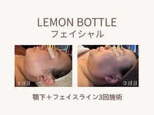ビーモア(B.MORE)/レモンボトルで小顔ケア♪
