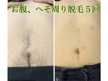 エニー(Any)/おへそまわり脱毛