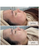 ヴィーナス(Venus)/ヒト幹細胞×美肌菌ピーリング 