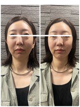 長寿鍼灸院 長寿整骨院/ハリネズミ女優美容鍼効果★