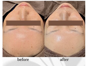 アン ビューティー(ann beauty)/【症例写真】40代女性