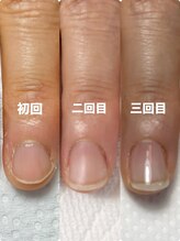 ハンド ケイ(Hand K)/自爪育成