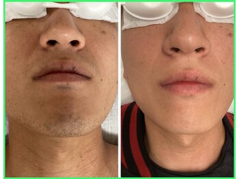 クリア 尾張旭店(Clear)/【Clear脱毛ビフォーアフター】