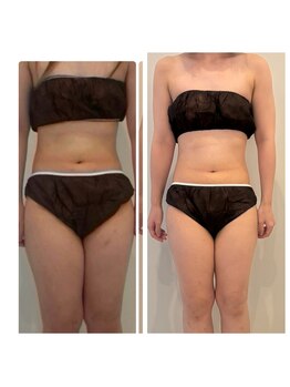 メゾン アンジュ(Maison Ange)/痩身コース/before&after