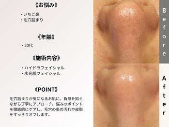 ルディラ 上野店/ハイドラフェイシャル