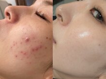 モルフォム(Morphome)/IPL光フェイシャル