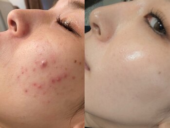 モルフォム(Morphome)/IPL光フェイシャル