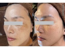 キレイ(KIREI)/before　＆　after