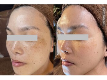 キレイ(KIREI)/before　＆　after