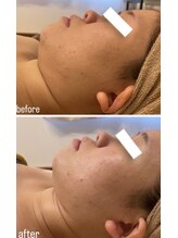 ソカ(SOKA)/首やフェイスラインもすっきり