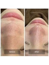 ケアナ 梅田店(CareNa)/ツヤ肌毛穴洗浄★ヒト由来幹細胞