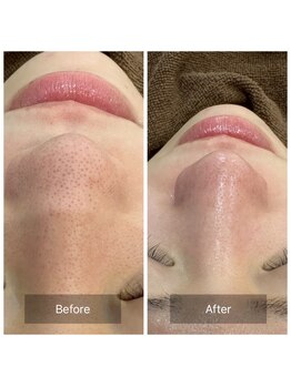 ケアナ 梅田店(CareNa)/ツヤ肌毛穴洗浄★ヒト由来幹細胞