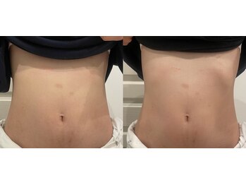 ルナート(Lunart)/腸もみの一回の変化