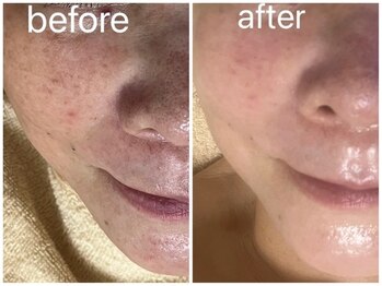 マイルーム(my room)/最強!エイジングケアコース