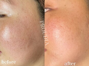 プラウディア(PROUDIA)/シミシワケア/目元の小皺ケア