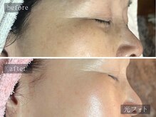 アムールサロン(Amour salon)/光フェイシャルでシミケア/新宿