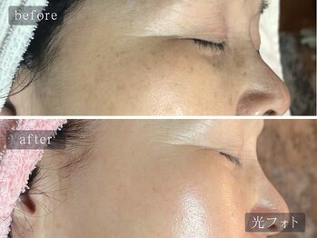 アムールサロン(Amour salon)/光フェイシャルでシミケア/新宿