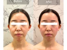 アファン 鶴見店(Afun)/小顔BeforeAfter