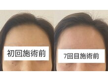 リアプア(Li'a)/丸くツヤ肌の額へ　ツヤ/美肌