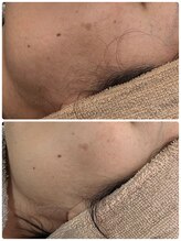 白の雫/角質汚れに｜毛穴洗浄後の変化