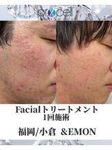 アンドエモン(&EMON)/【お顔】プロセル効果